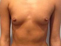 Breast Augmentation Case 4 Before