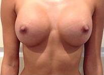 Breast Augmentation Case 4 After