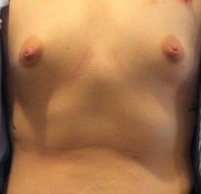 Breast Augmentation Case 5 Before