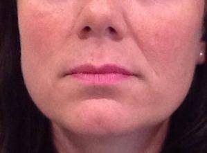 Dermal Fillers Case 1 Before