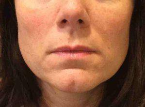 Dermal Fillers Case 1 After