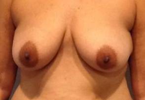 Breast Augmentation Case 6 Before