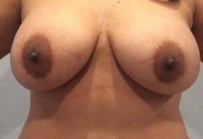 Breast Augmentation Case 6 After