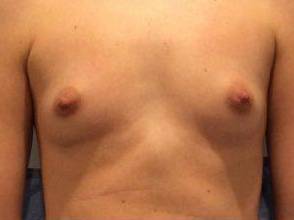 Breast Augmentation Case 7 Before