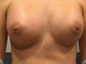 Breast Augmentation Case 7 After