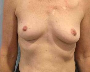 Breast Augmentation Case 11 Before