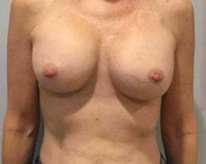 Breast Augmentation Case 11 After