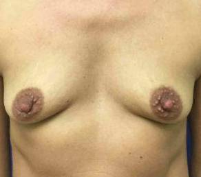 Breast Augmentation Case 12 Before