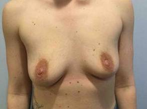 Breast Augmentation Case 13 Before