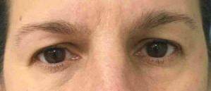 Blepharoplasty Case 5 Before