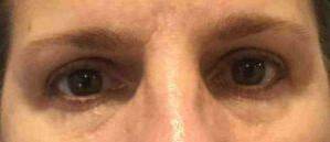 Blepharoplasty Case 5 After