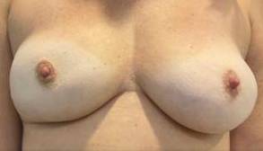 Breast Implant Removal Case 3 After