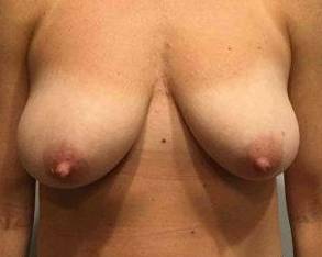 Breast Lift Case 1 Before