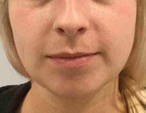 Chin Augmentation After