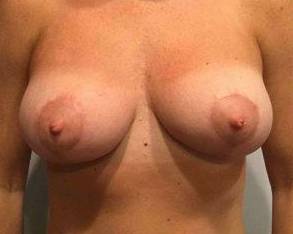 Breast Lift Case 1 After