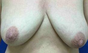 Breast Lift Case 2 Before