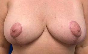 Breast Lift Case 2 After