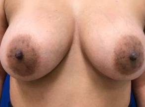 Breast Lift Case 3 Before