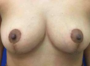 Breast Lift Case 3 After