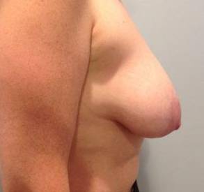 Breast Lift Case 4 Before