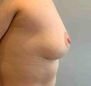 Breast Lift Case 4 After