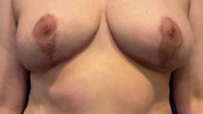 Breast Lift Case  5 After