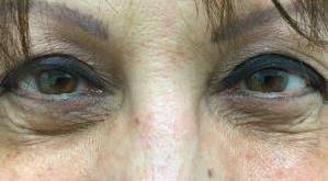 Blepharoplasty Case  4 Before