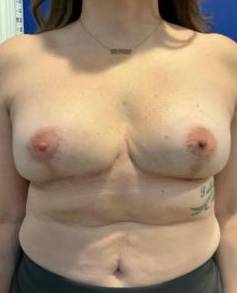 Breast Lift Case 7 After