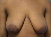 Breast Reduction Case 1 Before