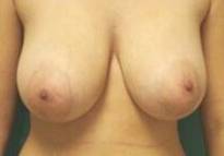 Breast Reduction Case 3 Before