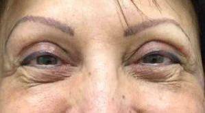 Blepharoplasty Case  4 After