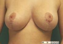 Breast Reduction Case 3 After