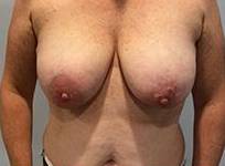 Breast Reduction Case 4 Before