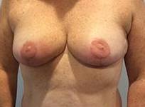 Breast Reduction Case 4 After