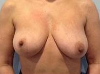 Breast Reduction Case 5 Before