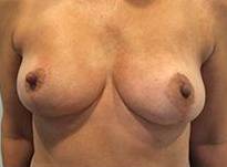 Breast Reduction Case 5 After