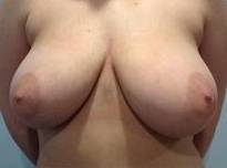 Breast Reduction Case 6 Before