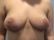 Breast Reduction Case 6 After