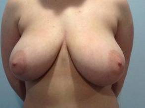 Breast Reduction Case 7 Before