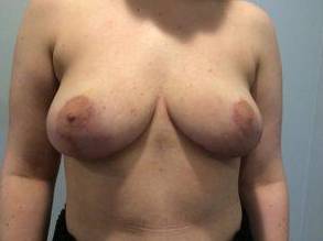 Breast Reduction Case 7 After