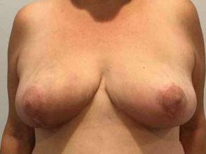 Breast Reduction Case 8 After