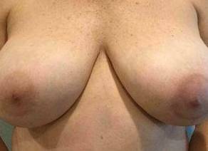 Breast Reduction Case 9 Before