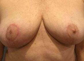 Breast Reduction Case 9 After