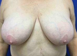 Breast Reduction Case 10 Before