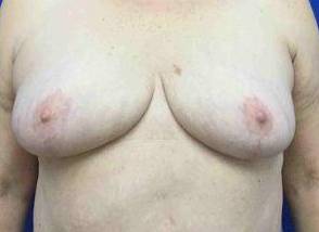 Breast Reduction Case 10 After