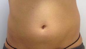 Coolsculpting Case 2 Before