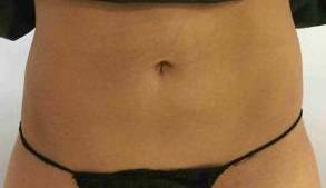 Coolsculpting Case 2 After