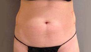 Coolsculpting Case 3 Before