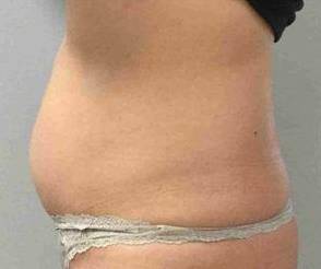 Coolsculpting Case 5 Before