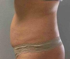 Coolsculpting Case 5 After